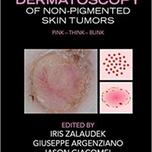 Dermatoscopy of Non-Pigmented Skin Tumors (Pink - Think - Blink) - eBook